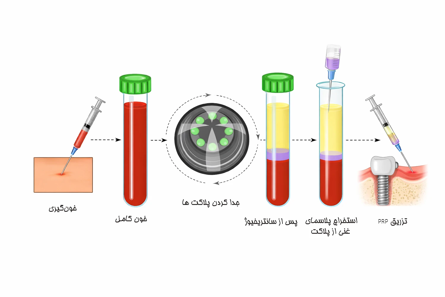 what is prp and how it made
