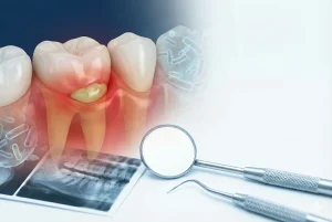 آبسه دندان چیست علائم نشنه ها پیشگیری درمان tooth abscess