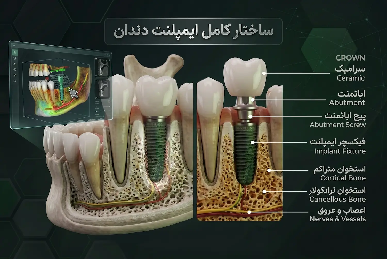 ساختار ایمپلنت آلمانی