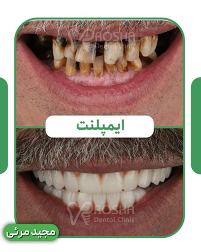 نمونه کار ایمپلنت مجید مرئی - 15 واحد ایمپلنت + سینوس لیفت + 24 واحد روکش