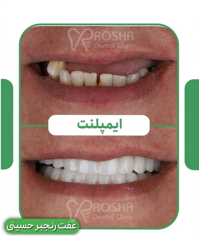 نمونه کار ایمپلنت عفت رنجبر حسینی : 15 واحد ایمپلنت + سینوس لیفت + 24 واحد روکش