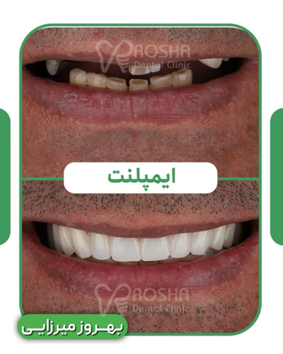 نمونه کار ایمپلنت : بهروز میرزایی - 14 واحد ایمپلنت + سینوس لیفت + 18 واحد روکش