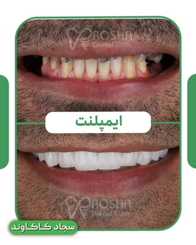 نمونه کار ایمپلنت سجاد کاکاوند : 12 واحد ایمپلنت + 17 واحد روکش