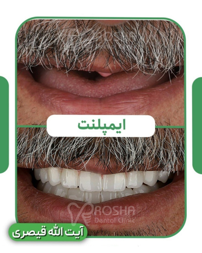 نمونه کار ایمپلنت آیت الله قیصری : 25 واحد ایمپلنت + سینوس لیفت + 24 واحد روکش