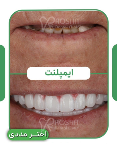 نمونه کار ایمپلنت اختر مددی : 15 واحد ایمپلنت + 25 واحد روکش